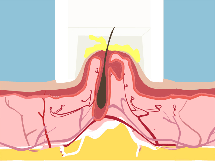 Microneedling_Illustration_2